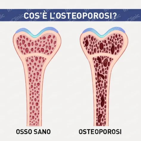 cosa è osteoporosi infografiche mediche