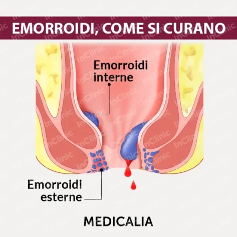 emorroidi infografica