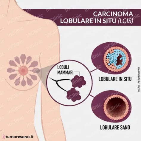 infografiche mediche carcinoma lobulare in situ