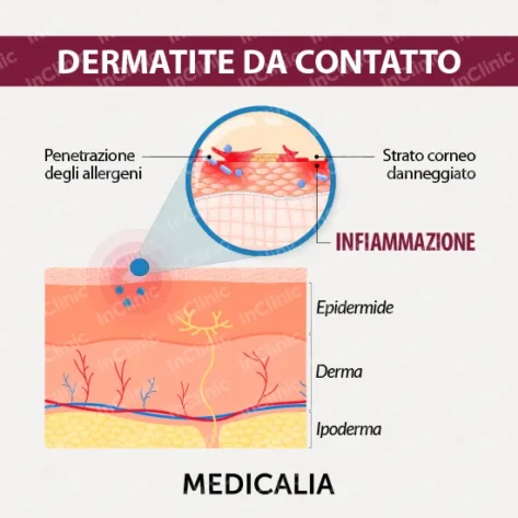 infografica dermatite da contatto