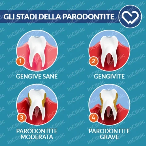 infografica stadi della parodontite