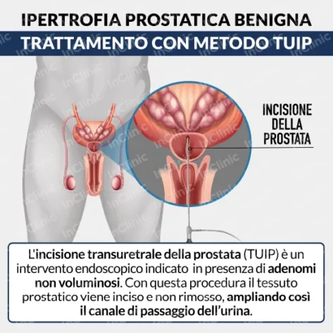 infografiche mediche tuip ipertrofia prostatica