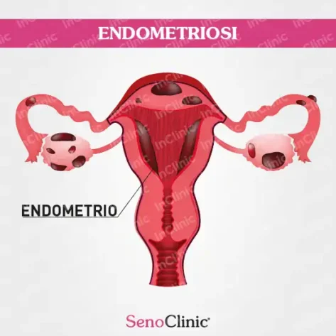 infografiche mediche endometriosi