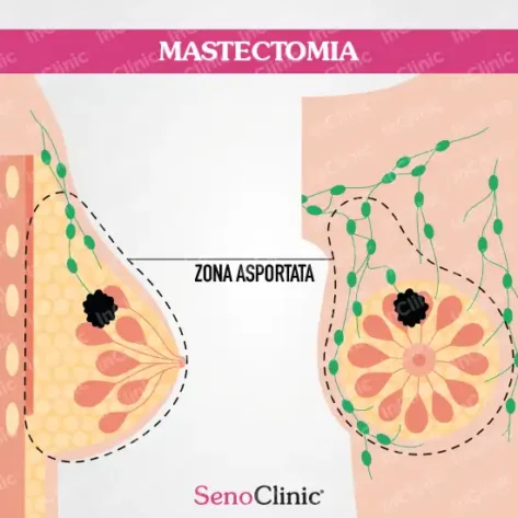infografiche mediche mastectomia
