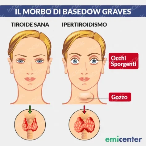 morbo di basedow graves infografca