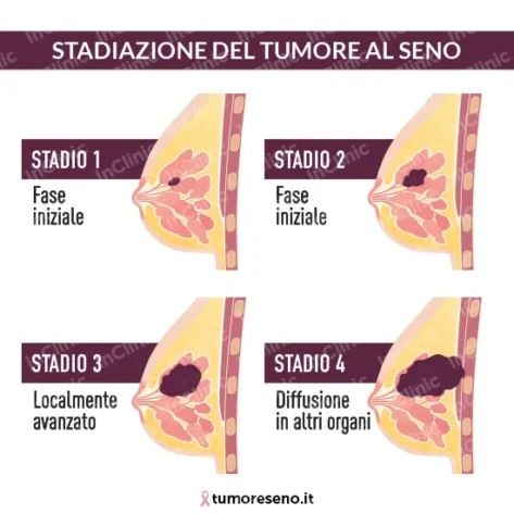stadi del tumore al seno infografica