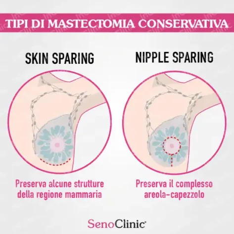 tipi di mastectomia conservativa immagini