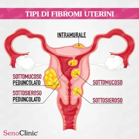tipi fibromi uterini immagini