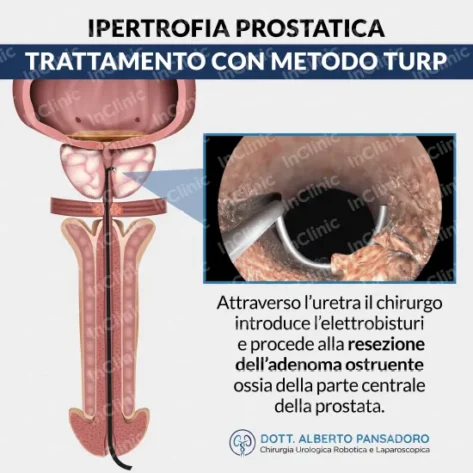 trattamento turp ipertrofia prostatica